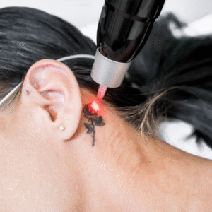 Eliminación de tatuajes