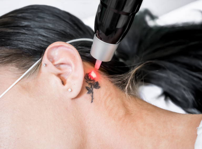 Eliminación de tatuajes