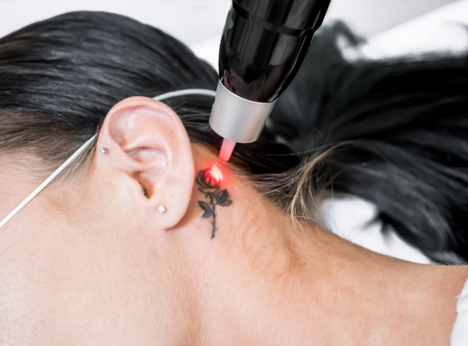 Eliminación de tatuajes